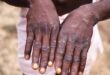 Monkeypox Outbreak: Ebonyi Govt Confirms One Case
